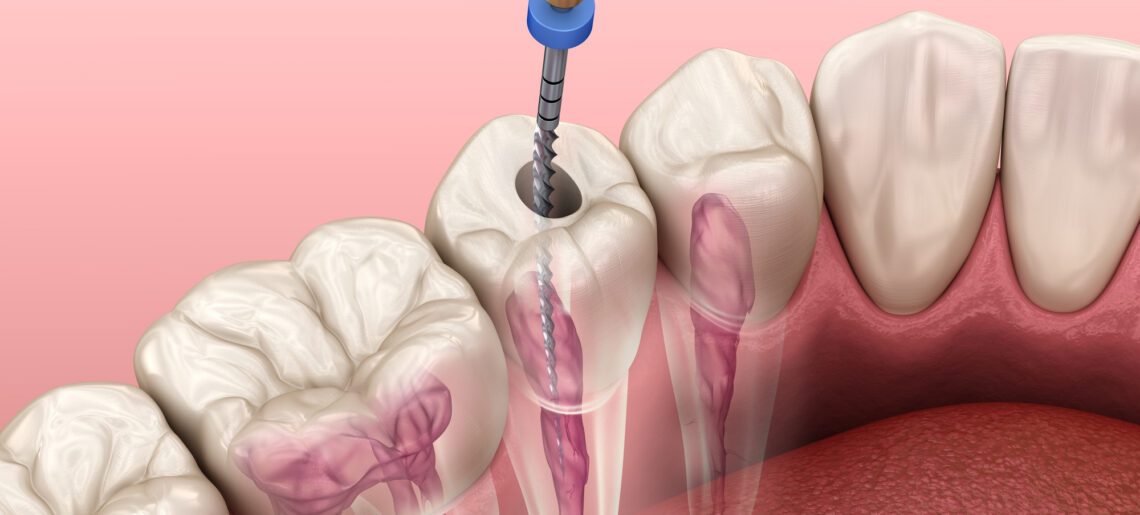 Revolutionizing Root Canals: The Latest in 2024 Treatment Techniques
